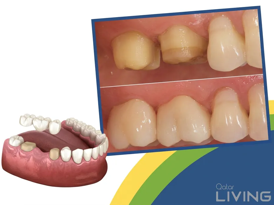 40% Off - High-Quality Dental Crown (Per Tooth)